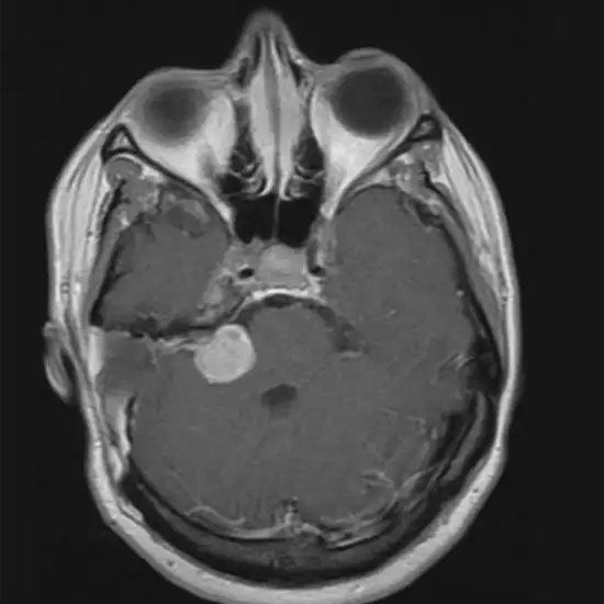 MRI Brain With CP Angle